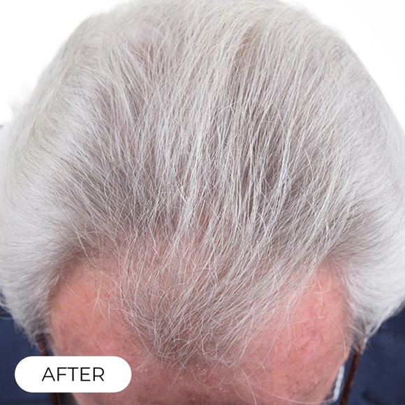 CapillusPro 202 Laser Therapy Cap. has an adapter for the European network. - Picture 12 of 14